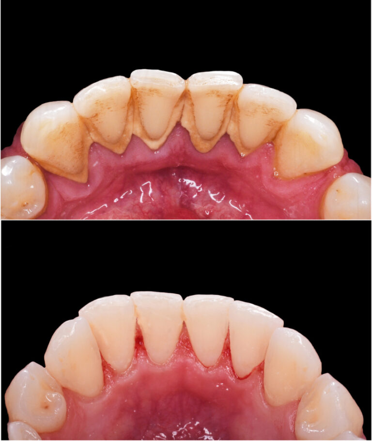 implante dentario antes e depois